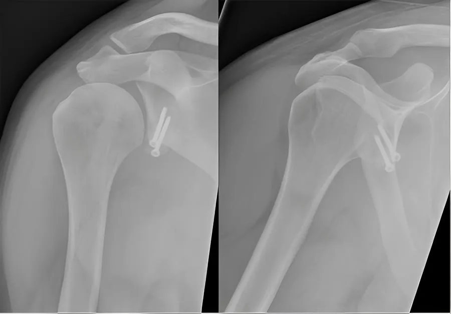 Bankart Lesion