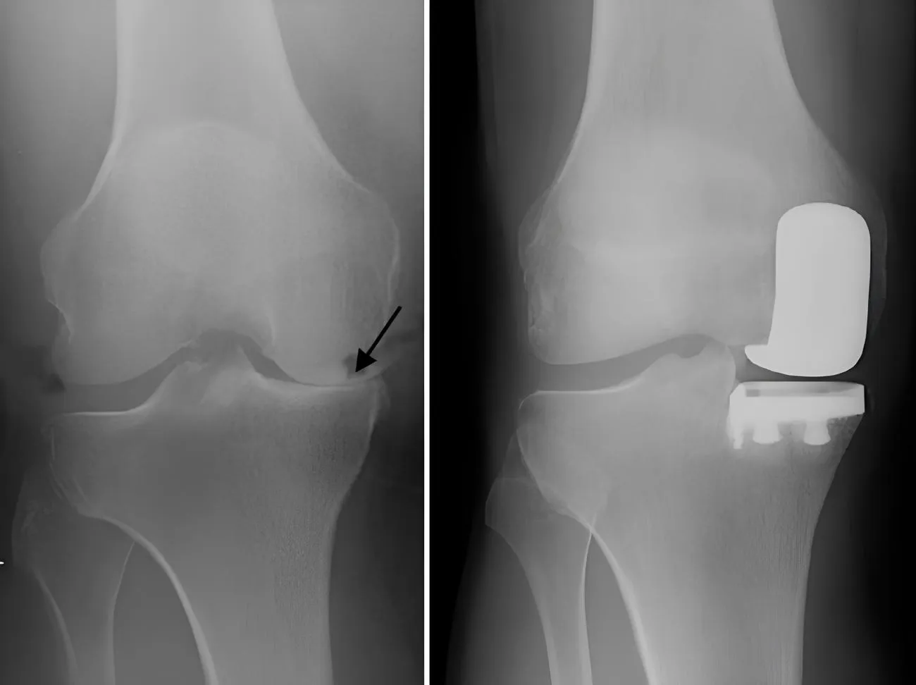 Partial Knee Replacement by microplasty