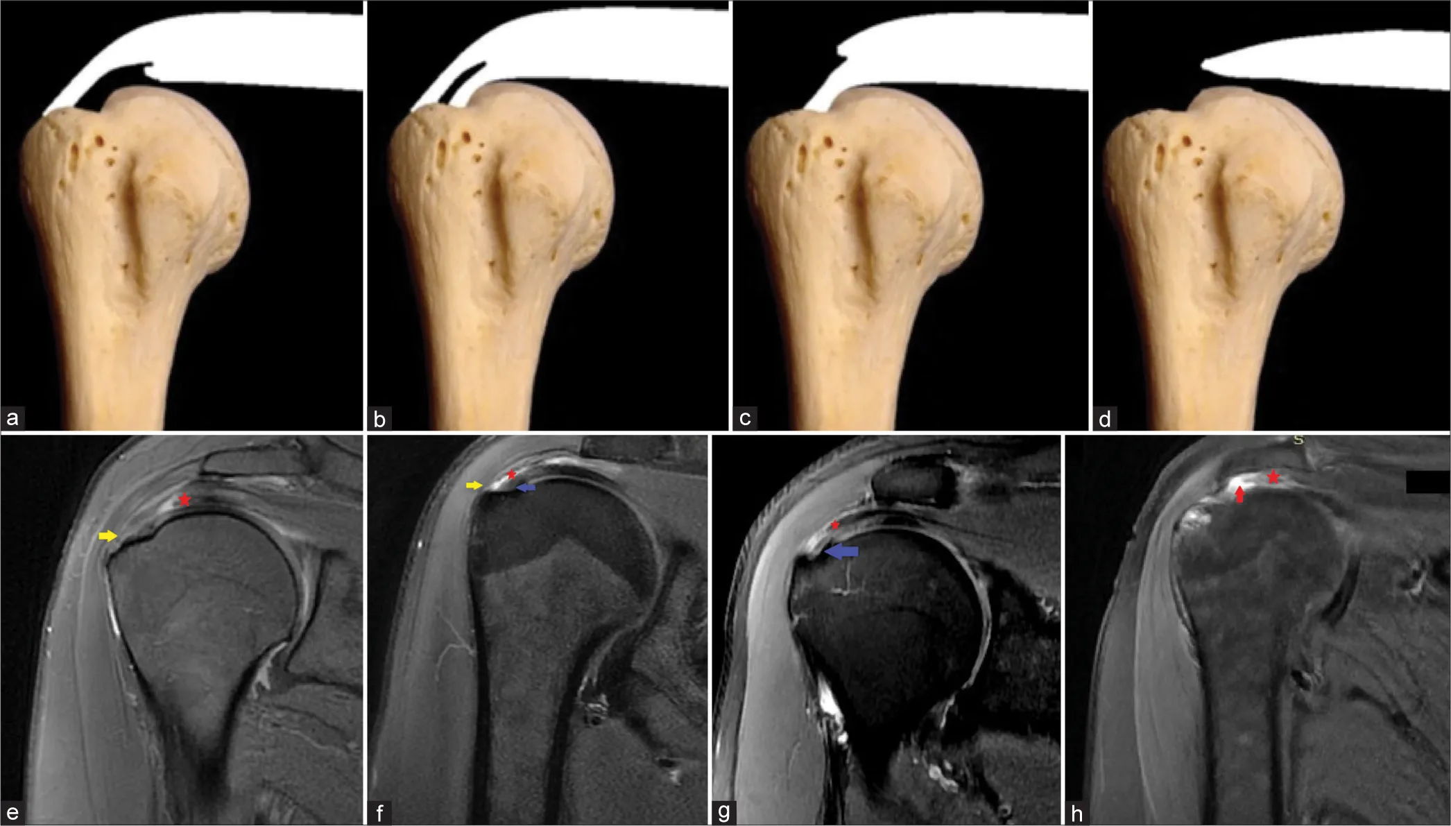 Rotator Cuff Tear