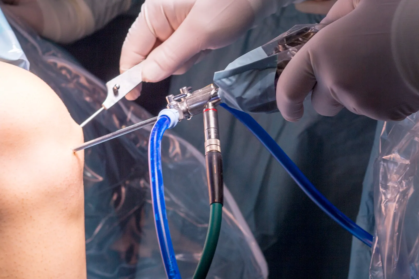 Shoulder Arthroscopy